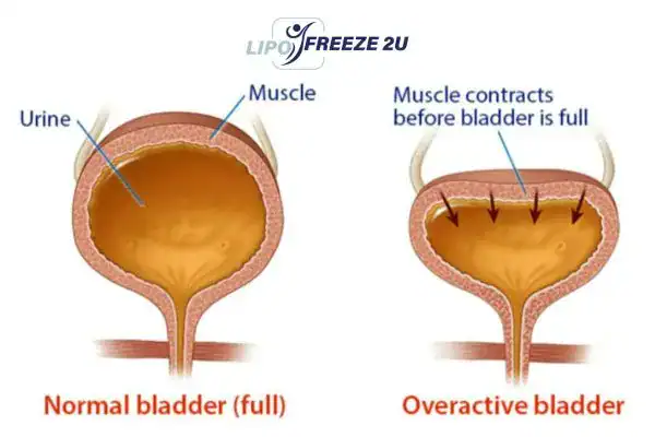 diagram of overactive bladder treatment Burgess Hill