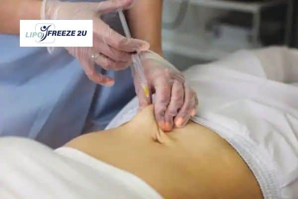 How Does Aqualyx Fat Dissolving Injection Work to Break Down Fat Burgess Hill?