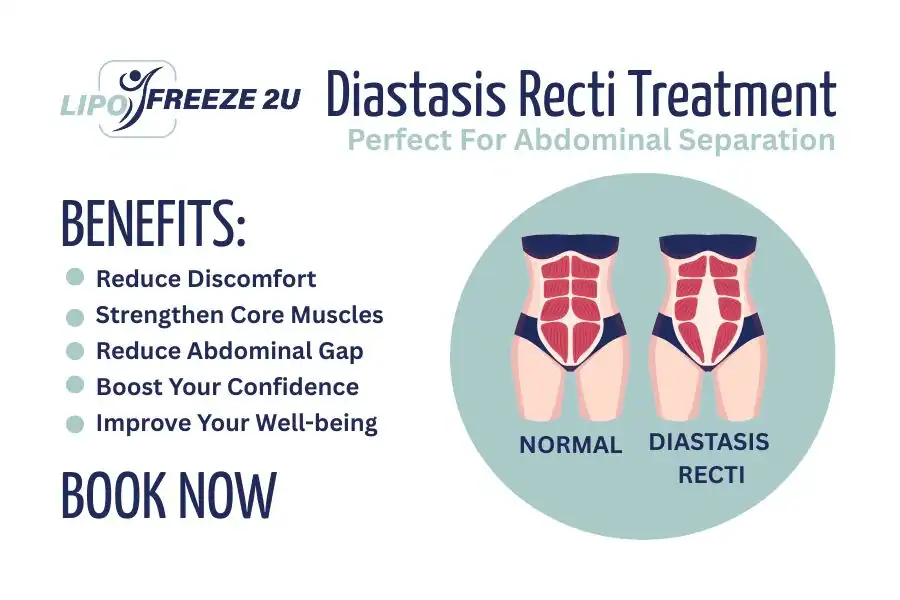 Benefits of body toning treatment Burgess Hill for Diastasis recti
