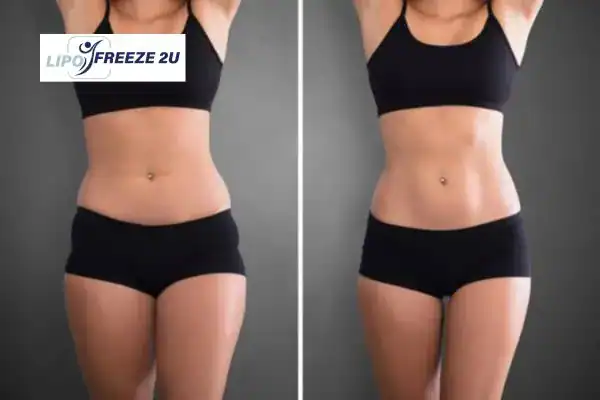 Body Toning Treatment Near Me in Burgess Hill, UK