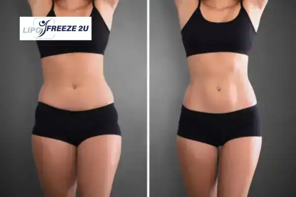 How Can LIPO FREEZE 2U Support Your Post-Pregnancy Body Recovery Burgess Hill?