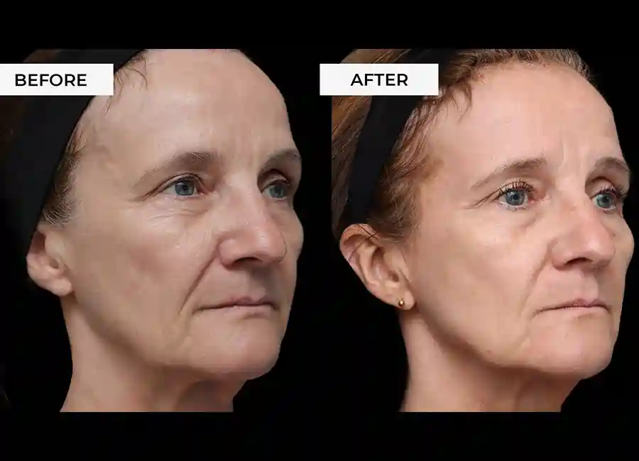 How Many RF Microneedling Sessions Will You Need to See a Difference Burgess Hill?