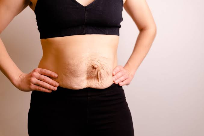 Is Surgery Really the Only Way to Repair Diastasis Recti Burgess Hill?