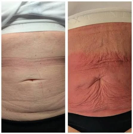 How Does RF Microneedling Improve Crepey, Thin and Uneven Skin Texture Burgess Hill?