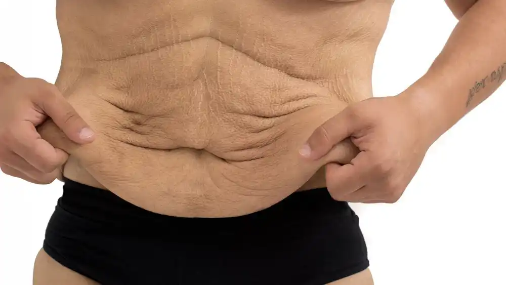 RF Microneedling for Loose Skin: How Can It Help Tighten and Reshape the Skin Burgess Hill?